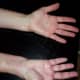 The palm of my right hand feels thick, and there is some tingling and lack of sensation in my fingertips.