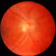 Although this isn't my retinal scan, it shows what vitreous floaters look like.