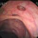 Small holes in the intestinal wall are characteristic of diverticular disease and can be viewed from a colonoscopy.