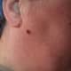 Mar 11, 2015. Wart has hardened, like a scab, and is smaller.