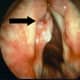 Polyps or vocal nodules (nodes)
