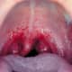 Severe sore throat with infection