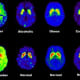 PET scans comparing addictions with normal brains.