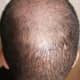 Vertex and Donor region. The redness has totally gone.