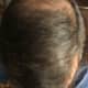 My Frontal and Temporal prior to HT