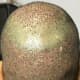 This is how the back of the head will look once the plaster is removed. As you can see it looks reddish in appearance and should look better as the days progress