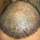 A frontal view of my crown. It looks reddish, but much better than earlier.