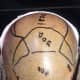 Markings done as to how many grafts goes in which part