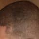 My frontal / temporal region, thats the only place where it is still obviously visible that i underwent a hair transplant