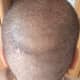 My Vertex and Donor region. Donor region is almost completely healed.