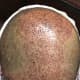 This is how your scalp will look on the 2nd day if you follow the directions given by the doctor