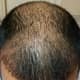 Top view - - almost all the transplanted hair has fallen off. This is expected as per the transplant timelines
