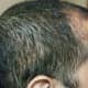 Side view - - almost all the transplanted hair has fallen off