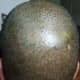 The back and vertex region. A little bit more cover of hair in my donor region which has slightly masked the redness