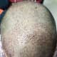 The frontal/temporal area, you can see that i have not lost any graft and it is appearing better than earlier