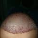 Frontal area post hair transplant