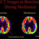 Brain scan of Tibetan Buddhist meditators. Meditating on the right shows decreased activity in the parietal lobe. The parietal lobe handles orientation in space and time providing feeling of “spacelessness” and “timelessness” during religious experie