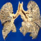 Chronic Diseases Of the Lungs. This slide shows Centrilobular Emphysema.
