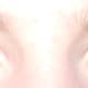 Sectoral heterochromia is probably the most common type of heterochromia.