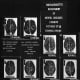 An image of a 1920s image attempting to associate brain types to criminal behaviour. The theory is named biological determinism - heredity, more than environment or education, the idea went, caused social problems.