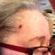 Oct 5, 2015. Five days after wart fell off. At this point no oregano. Frankincense or Lavender oils to help healing.