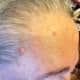 Jul 31, 2015. Notice large pink circle in the hairline, and smaller irregular shaped raised area, which was raised and rough. Notice multiple lesions on right forehead