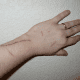 Scratches on the hand.