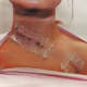 2) This one came within 2mm of her carotid artery. 