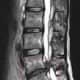 Herniated Spinal Disk and Narrowed Nerve Root