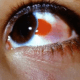 burst-blood-vessel-in-eye-symptoms-causes-treatment