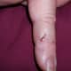 Laceration-like wound on the ulnar aspect of right index finger. Residual masque adhering to wound. Wounds already healing on day 2.