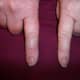 Injured index finger on left. Circumference 5 mm greater at the base of the finger than the other index finger. Circumference 7 mm greater at the tip.