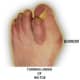 bunion