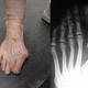 bunion