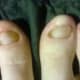 April 26, 2014. I am so excited about my progress! I see more new, clear nails growing underneath the fungus ones. Yay!