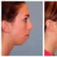 A receding chin is a good reason for an implant