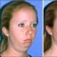 Chin implants increase self-esteem