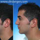 Nose and chin surgery balance the face for improved harmony