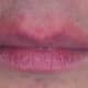 Redness (erythema) around the lips. 
