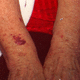 Senile purpora on the arms.
