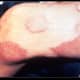 Leg lesions - Hansen's Disease - Leprosy