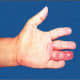 Hand lesion - Leprosy