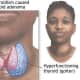thyrotoxicosis-personal-experiences-of-living-with-thyroid-problems