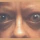 Thyrotoxicosis can cause the eyes to bulge.