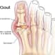 Gout