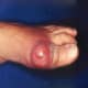 Acute podagra due to gout in an elderly man.