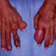 Chronic tophaceous gout in an untreated patient with end-stage renal disease.