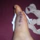 Image of my foot 5 days after bunion surgery- the scar.