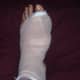 My foot after bunion surgery- bandaged