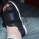 Image of my foot after bunion surgery- surgical shoe
